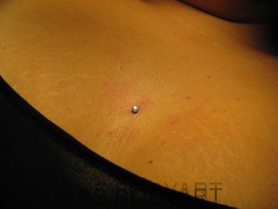 Microdermal im Gesicht