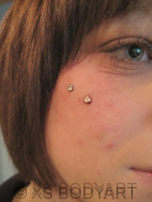 Microdermal am Hals